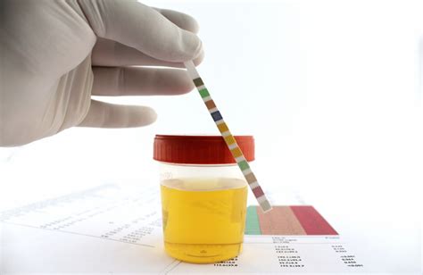 Urine Culture Test .